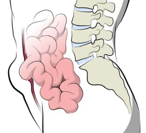 HerniaA