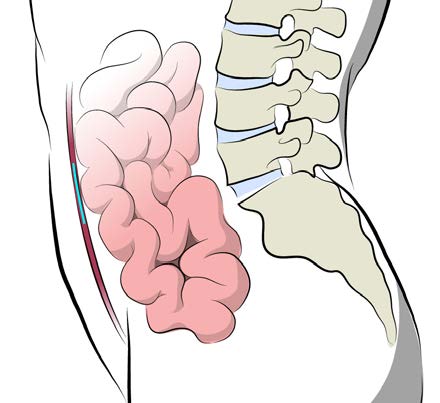 Robotic Inguinal Hernia Repair Drrekkas Hot Sex Picture